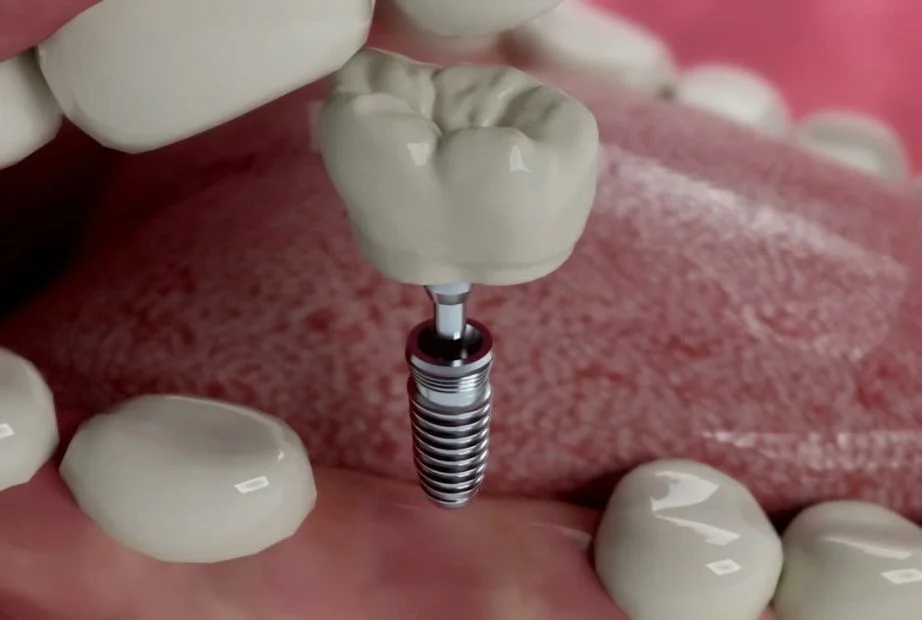 implantes dentales tomares